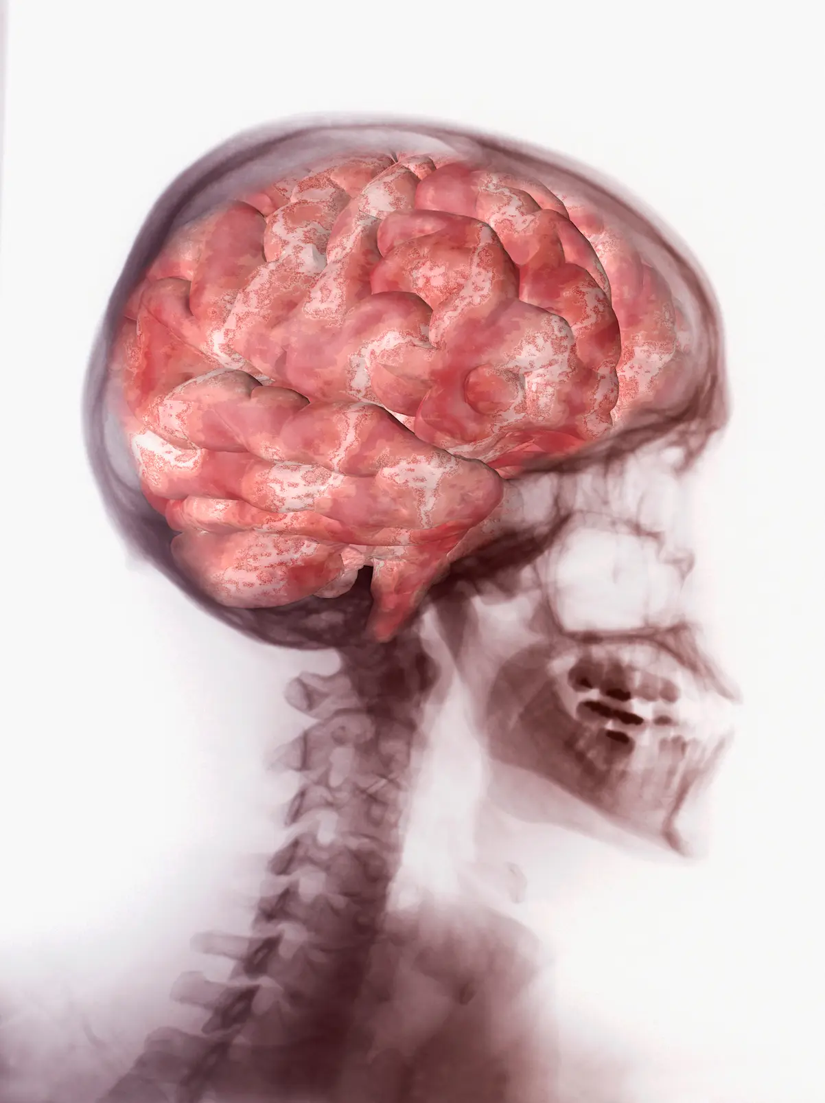 Cerebro con exosomas de MSC y neuronas dopaminérgicas