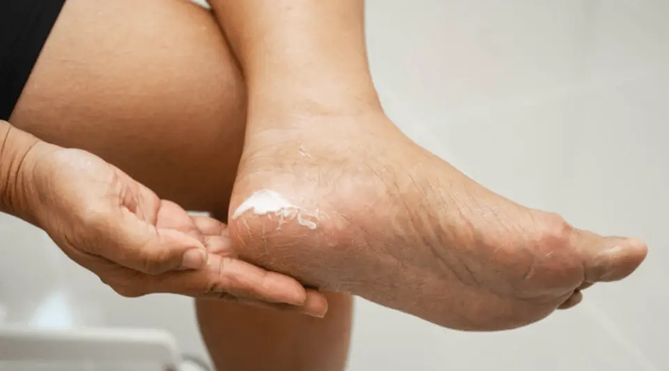 Funciones y mecanismos de las células madre mesenquimales del cordón umbilical en el tratamiento del pie diabético: una revisión de estudios preclínicos y clínicos